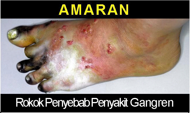 Malaysia 2008 Health Effects Vascular System - gangrene, lived experience (front)